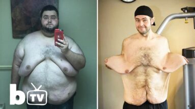 My 300lbs Weight Loss Left Me With 13lbs Of Loose Skin